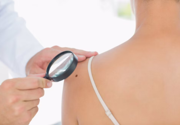 Screenshot 2026-04-16 at 16-30-11 Cómo la IA podría anticipar el desarrollo de melanoma hasta cinco años antes - Infobae